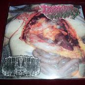 Genital Herpes / Butyric Fermentation Abuse