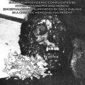 SHUNT PORTOSYSTEMIC COMPLICATED BY HYPERAMMONEMIA AND HEPATIC ENCEPHALOPATHY SUPPORTED BY DAILY DIALYSIS IN A CHRONIC HEMODIALYSIS PATIENT