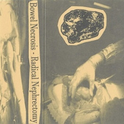 Radical Nephrectomy