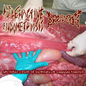 Necrotic Crust Of Ulcerative Vaginal Tumour