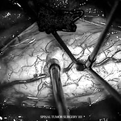 Spinal Tumor Surgery 101