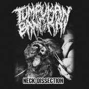 Neck Dissection