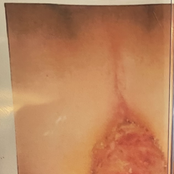 Diarrhetic Prolapse Expulsion