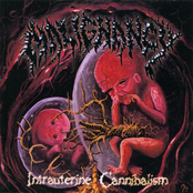 Intrauterine Cannibalism by Malignancy