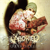 Parasitic Flesh Resection by Aborted