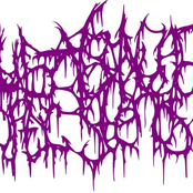 Cerebral Cortical Heterotopia