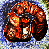 Liquid Diarrhea