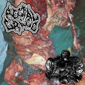 Rectal Grace/Esthesioneuroblastoma Submucosal - Split