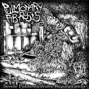 Severe Pulmonic Valve Regurgitation