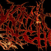 Reeking Infant Tubercular Phlegm