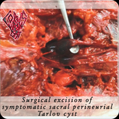 Surgical Excision Of Symptomatic Sacral Perineurial Tarlov Cyst