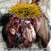 Parasitic Myoneuroma Of Sessile Pseudopolyps Similarly Concurrent Of Decubiteal-Like Ulcerous Inflammation