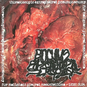 thoracoscopic extrapleural pneumonectomy for malignant pleural mesothelioma - DEMO 2024