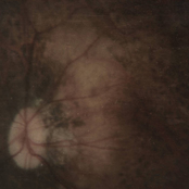 Bereft of Xerotic Layers (Album)