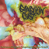 Cutaneous Metastatic Fungating Ulcerative Growth