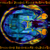 Traumatic Pineal Gland Extraction