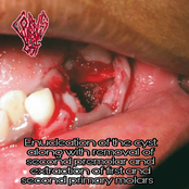 Enucleation of the cyst with removal of second premolar and extraction of first and second primary molars
