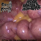 Renal Hydronephrosis​ /​ Perky Macabre