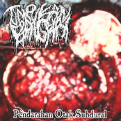 Pendarahan Otak Subdural