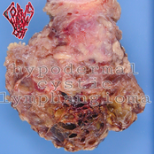 Hypodermal Cystic Lymphangioma