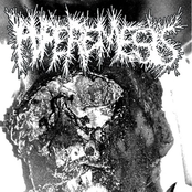 Hyperemesis / Neisseria Gonorrhoeae