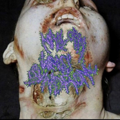 Intracerebral Hemorrhage