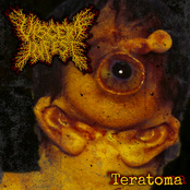 Teratoma
