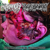 Orbitomaxillofacial Mucormycosis