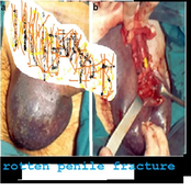 Rotten Penile Fracture