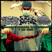 Paroxysmal Nocturnal Hemoglobinuria