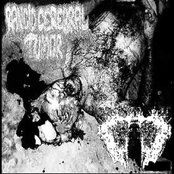Rancid Cerebral Tumor / Carcinomas Of Unknown Primary Origin
