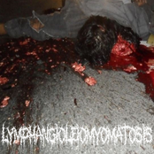 Lymphangioleiomyomatosis