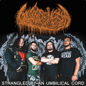 Strangled By An Umbilical Cord