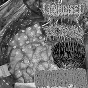 Amebic Meningoencephalitis Due to Naegleria Fowleri