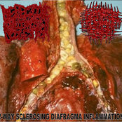 2-Way Sclerosing Diafragma Inflammation