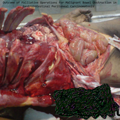 Outcome of Palliative Operations for Malignant Bowel Obstruction in Gastrointestinal Peritoneal Carcinomatosis