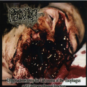 Lymphadenectomy For Carcinom..