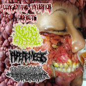 4 Way Hemangiopericytoma