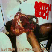 Estomatitis Candidiasica