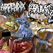 Mincegore appendix removal