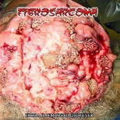 fibrosarcoma