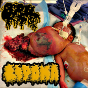 Lipoma / Calcified Fetus
