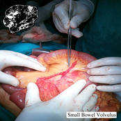 Small Bowel Volvulus