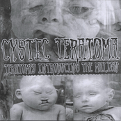 Teratomes Introducing The Malign