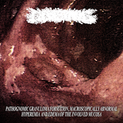 Pathognomonic Granuloma Formation, Macroscopically Abnormal Hyperemia and Edema of the Involved Mucosa