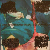 4 Ways to Surgically Extract the Esophagus