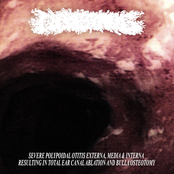 Severe Polypoidal Otitis Externa, Media & Interna Resulting In Total Ear Canal Ablation and Bulla Osteotomy