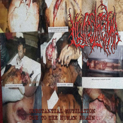 Substantial Mutilation Due To The Human Brain