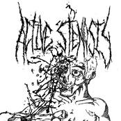 Split with Hyperemesis