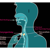 Laryngectomy